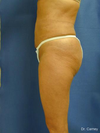 Virginia Beach Liposuction 1213 - After Image 3