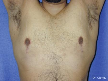 Virginia Beach Gynecomastia 1255 - After Image 2