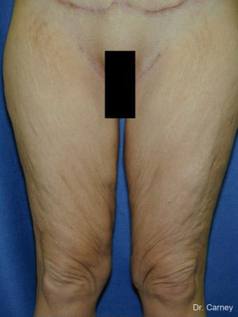 Virginia Beach Thigh Lift 1252 - After Image 2