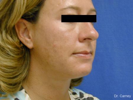 Virginia Beach Neck Lift 1267 - After Image 3