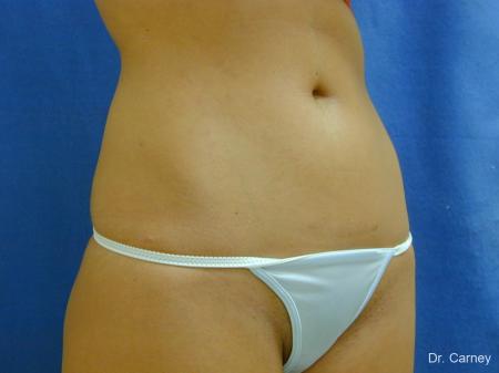 Virginia Beach Liposuction 1277 - After Image 2