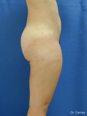 Virginia Beach Liposuction 1285 - After Image 4