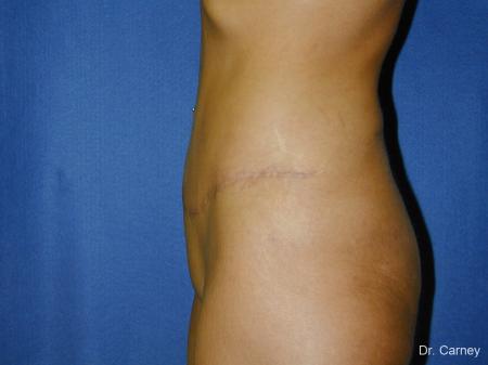 Tummy Tuck: Patient 1 - After Image 3
