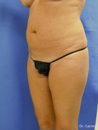 Virginia Beach Liposuction 1279 - Before Image 3