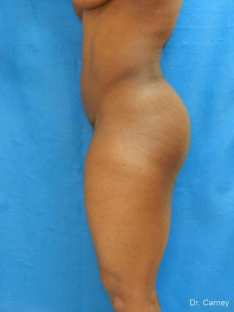 Brazilian Butt Lift: Patient 3 - Before Image 2