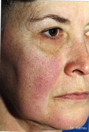 Virginia Beach Laser Skin Resurfacing - Face 1259 - Before and After Image 3