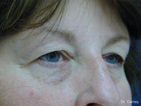 Virginia Beach Eyelid Lift 1129 - Before Image 2
