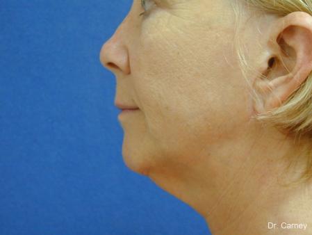 Virginia Beach Laser Skin Resurfacing - Face 1260 - Before and After Image 3