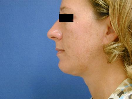 Virginia Beach Neck Lift 1267 - After Image 4
