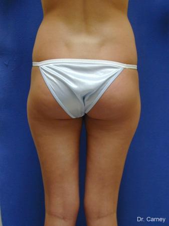 Virginia Beach Liposuction 1277 - Before Image 3