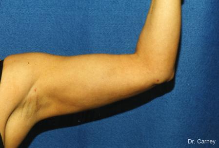 Virginia Beach Brachioplasty 1141 - After Image 1