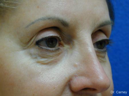 Virginia Beach Eyelid Lift 1131 - Before Image 2