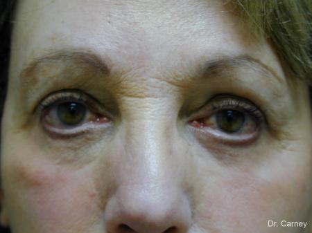 Virginia Beach Eyelid Lift 1128 - After Image 1