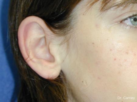 Virginia Beach Otoplasty Earlobe Repair 1271 - Before and After Image 4