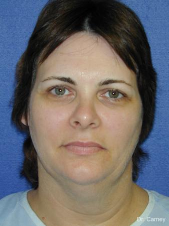 Virginia Beach Facelift 1136 - Before and After Image 3