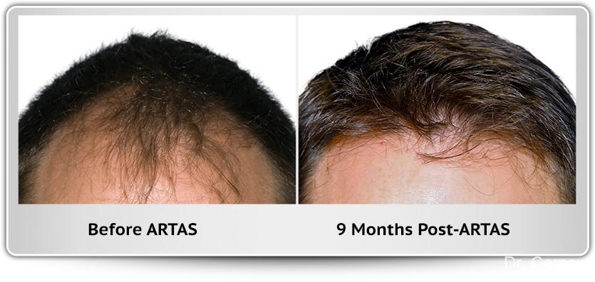 Hair Transplantation: Patient 6 - Before and After  