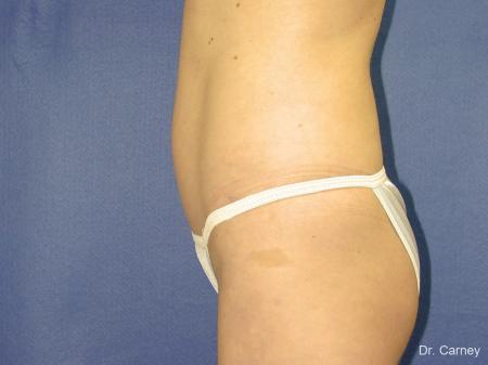 Virginia Beach Liposuction 1280 - Before Image 3