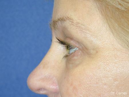 Virginia Beach Brow Lift 1345 - After Image 5