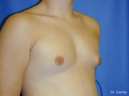 Virginia Beach Gynecomastia - Before Image 2