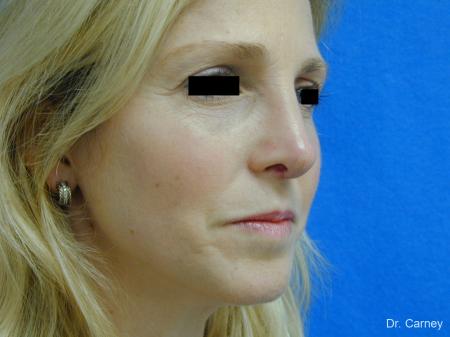Virginia Beach Rhinoplasty 1343 - After Image 3