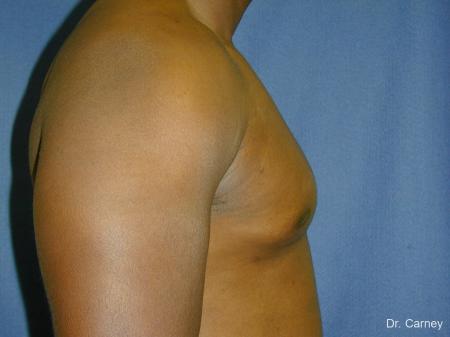 Virginia Beach Gynecomastia 1226 - After Image 4