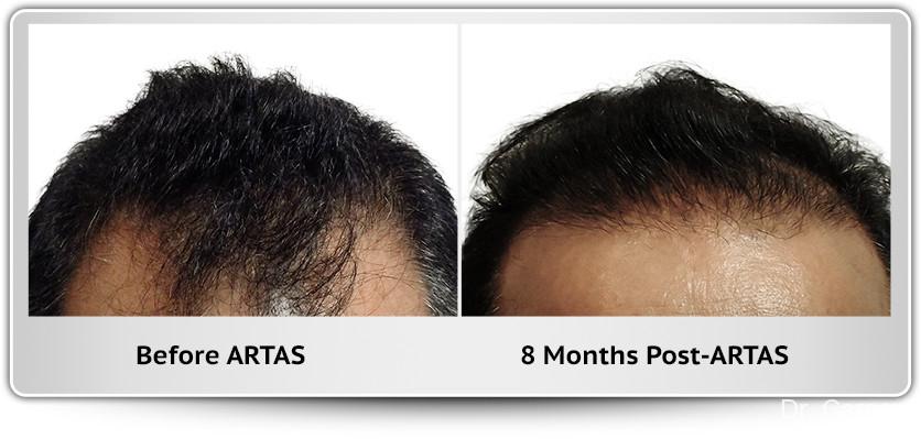 Hair Transplantation: Patient 4 - Before and After 1