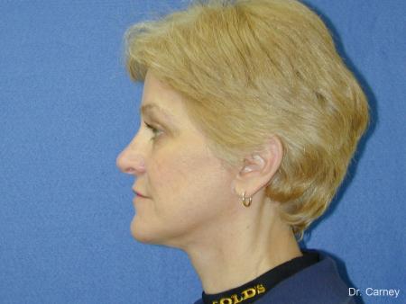 Virginia Beach Facelift 1346 - After Image 4