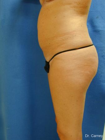 Virginia Beach Liposuction 1279 - Before and After Image 5