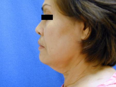 Virginia Beach Neck Lift 1268 - Before and After Image 3