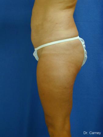 Virginia Beach Liposuction 1284 - After Image 3