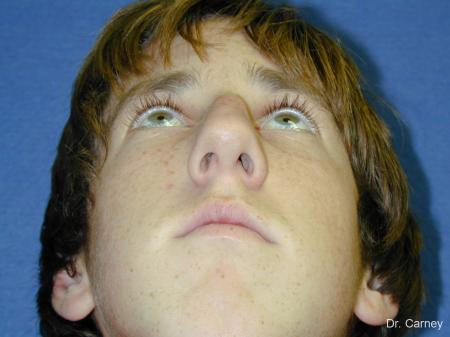 Virginia Beach Rhinoplasty 1219 - Before and After Image 5