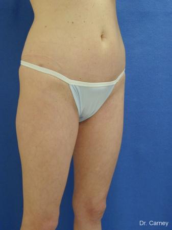 Virginia Beach Liposuction 1280 - Before and After Image 5