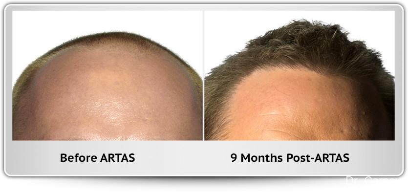 Hair Transplantation: Patient 15 - Before and After Image 1