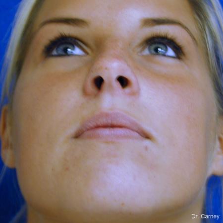 Virginia Beach Rhinoplasty 1218 - Before Image 2