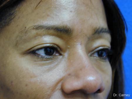 Virginia Beach Eyelid Lift 1130 - Before Image 1