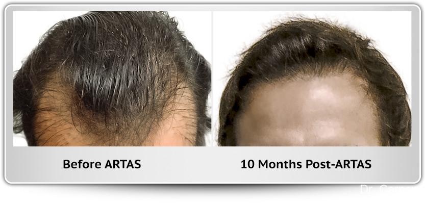Hair Transplantation: Patient 13 - Before and After 1
