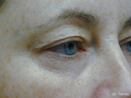 Virginia Beach Eyelid Lift 1138 - Before Image 2