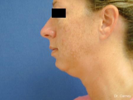 Virginia Beach Neck Lift 1267 - Before and After Image 4