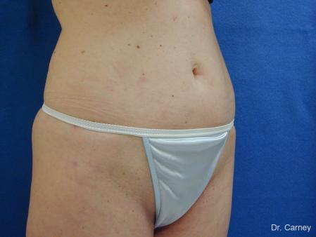 Virginia Beach Liposuction 1280 - After Image 4