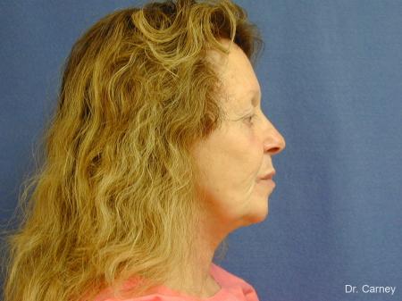 Virginia Beach Facelift 1127 - Before Image 2