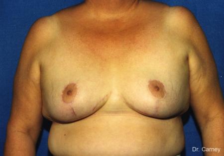 Virginia Beach Breast Lift 1186 - After Image 1