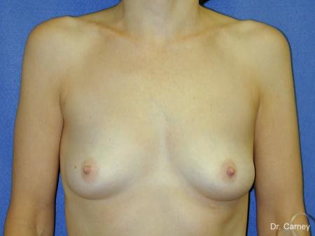 Virginia Beach Breast Augmentation 1088 - Before and After Image 3