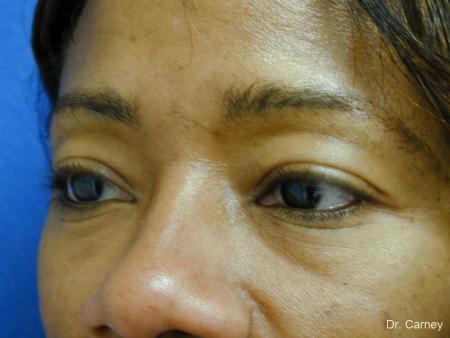 Virginia Beach Eyelid Lift 1130 - Before and After Image 2