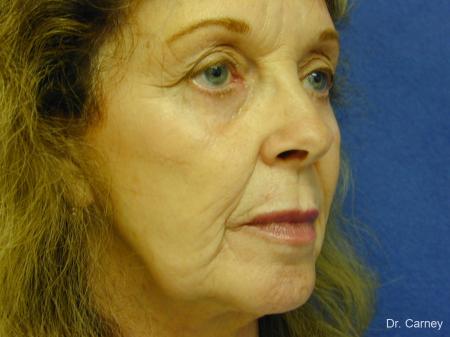 Virginia Beach Facelift 1127 - Before Image 1