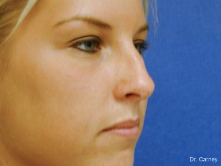 Virginia Beach Rhinoplasty 1218 - Before Image 4