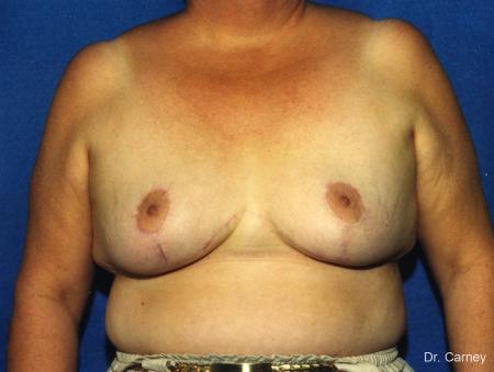 Virginia Beach Breast Reduction 1234 - After Image 1
