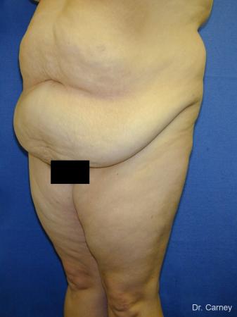 Virginia Beach Tummy Tuck 1250 - Before Image 1