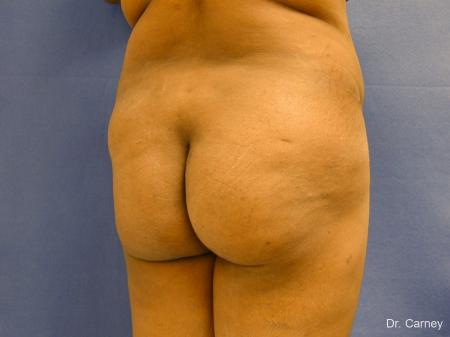 Virginia Beach Brazilian Butt Lift 1220 - Before Image 4