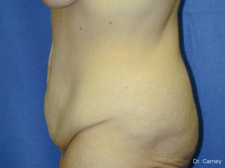 Virginia Beach Tummy Tuck 1249 - Before and After Image 3