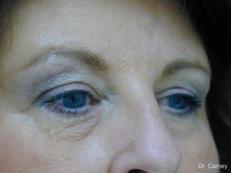 Virginia Beach Eyelid Lift 1129 - After Image 2
